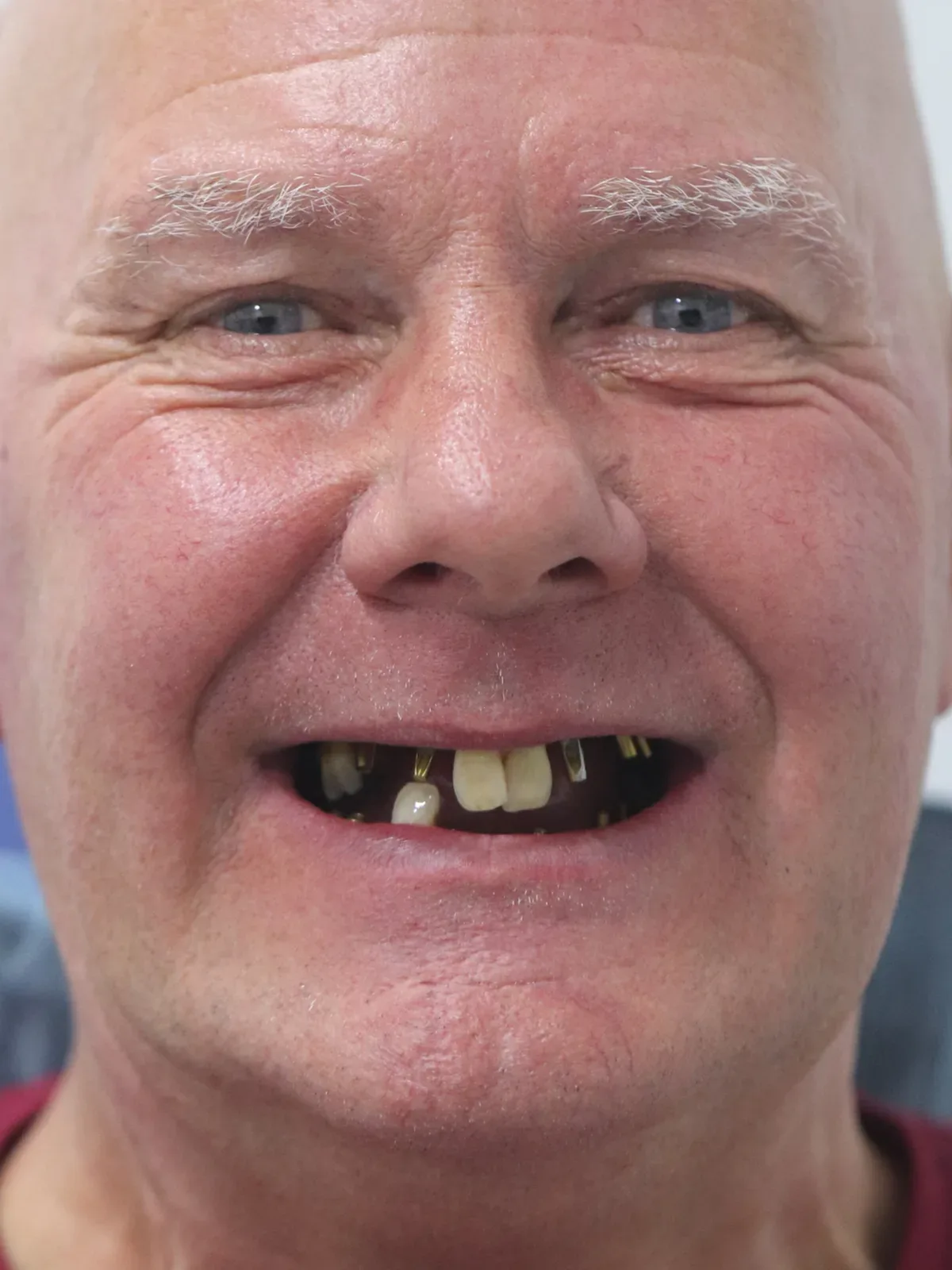 Before: Smile