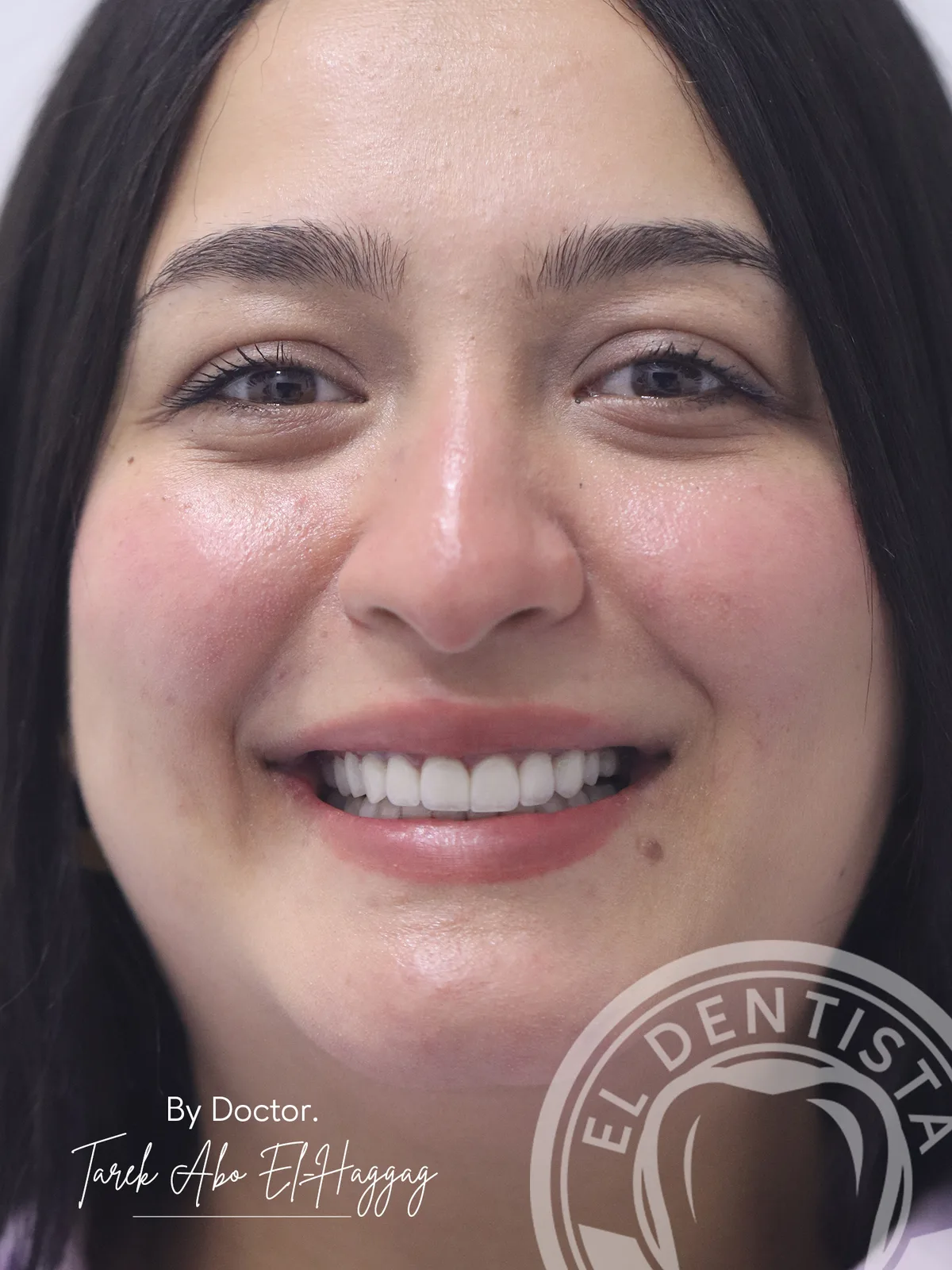 After: Smile