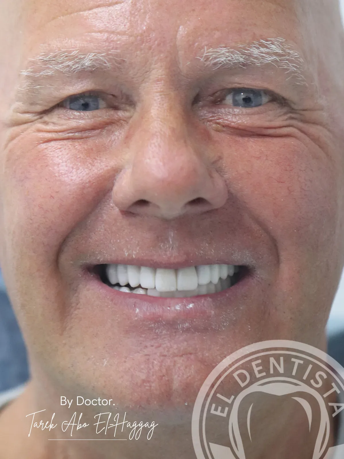 After: Smile