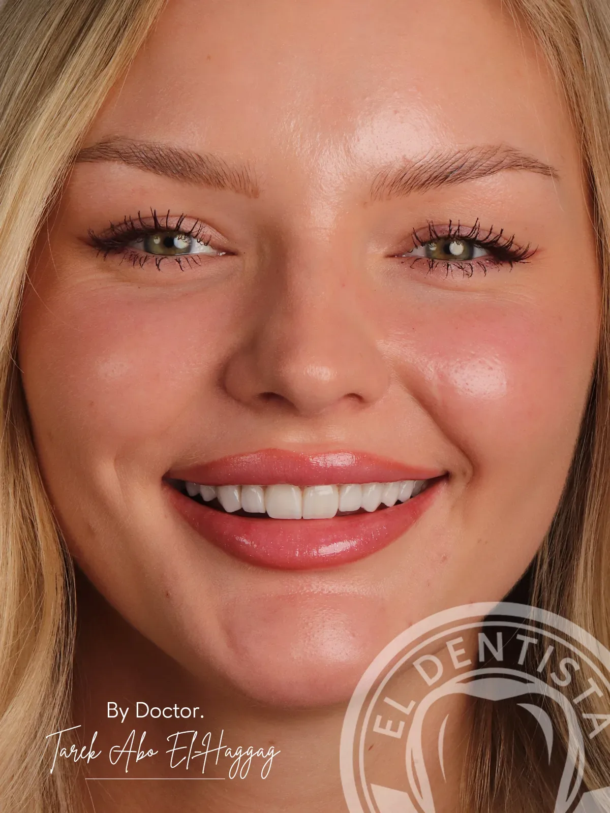 After: Smile