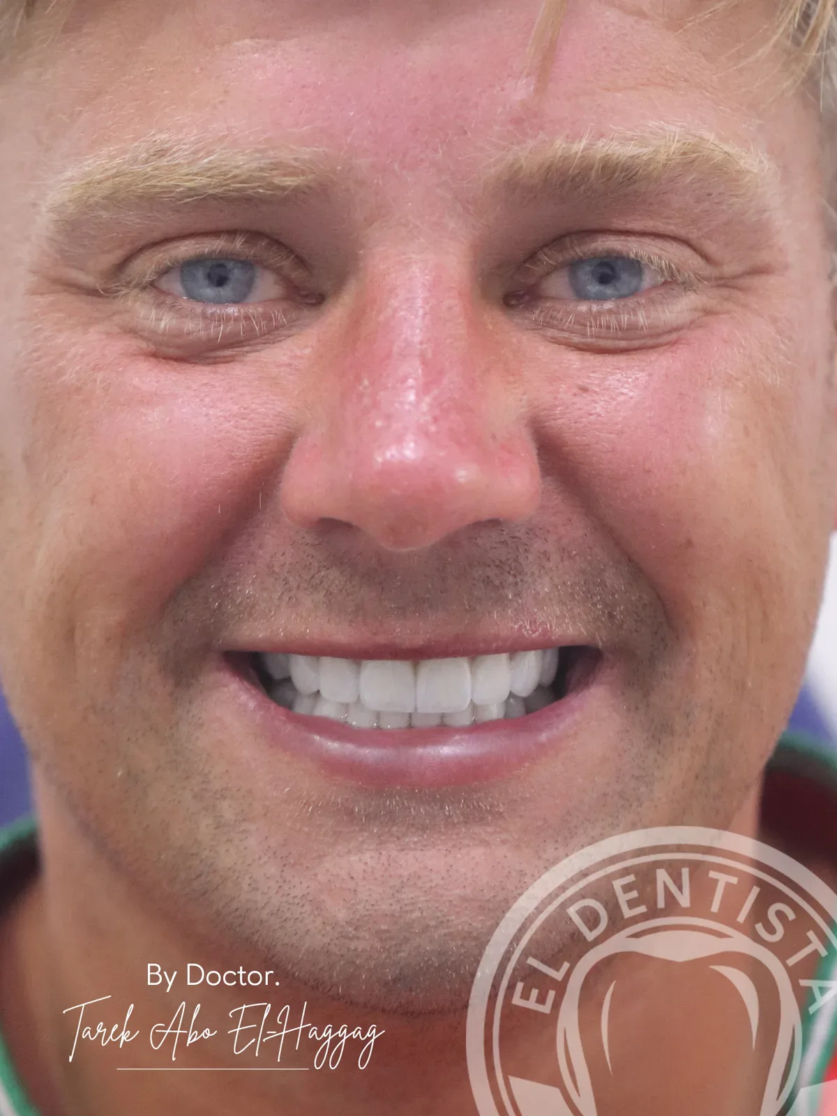 After: Smile