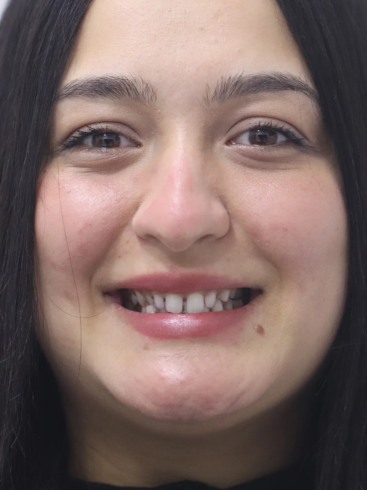 Before: Smile