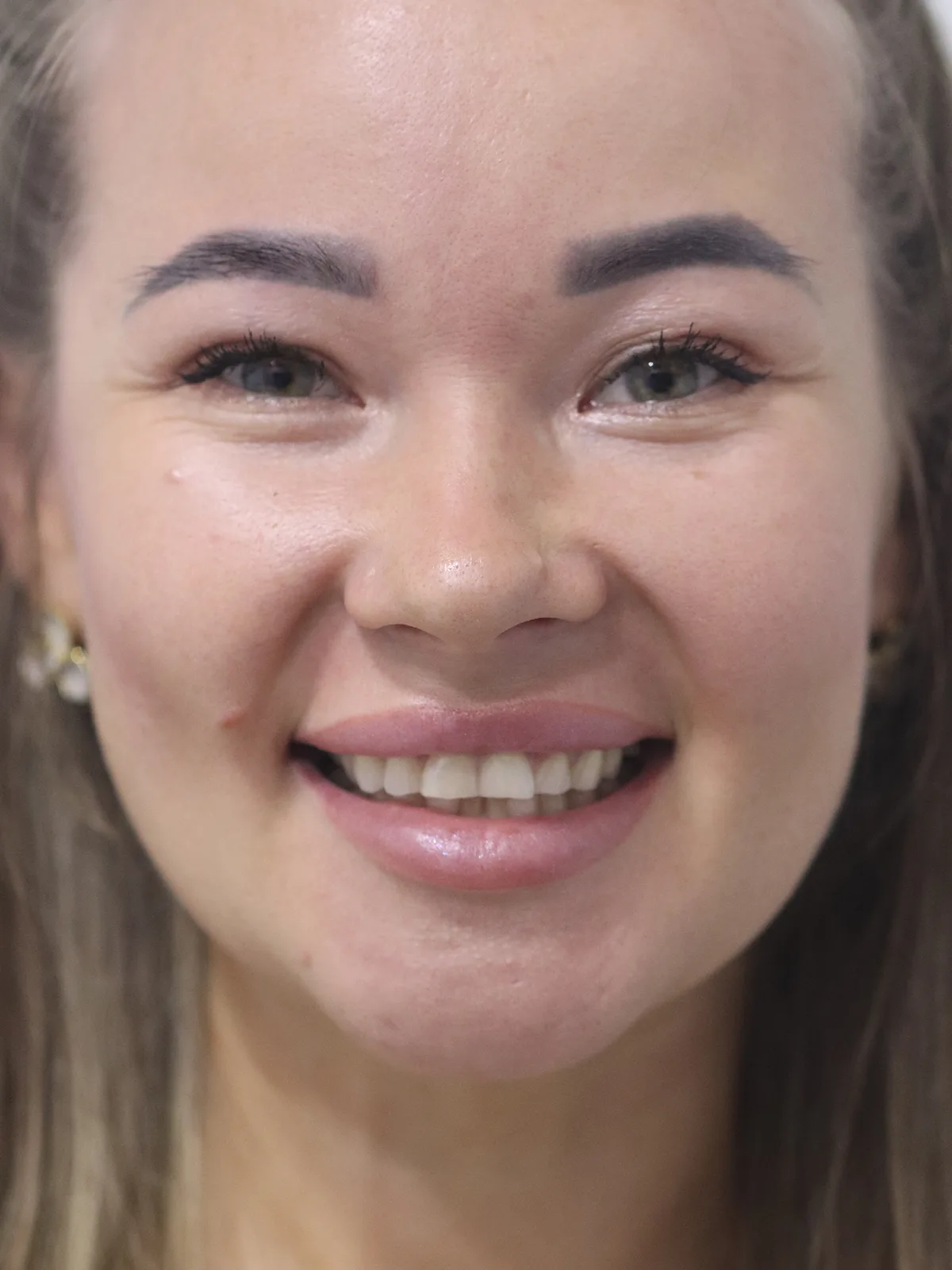 Before: Feldspathic Veneers