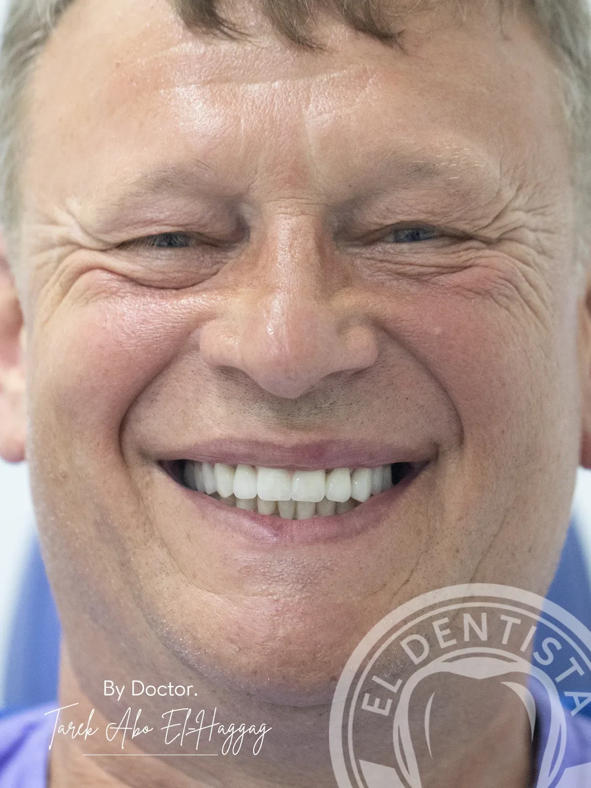 After: Smile