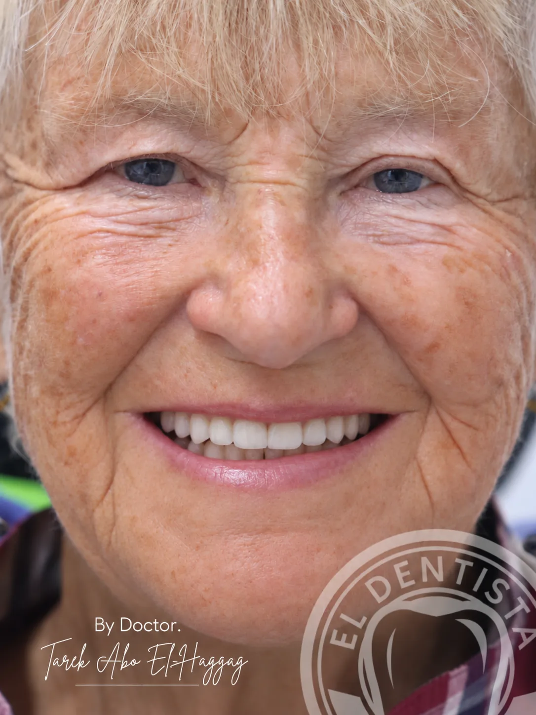 After: Smile