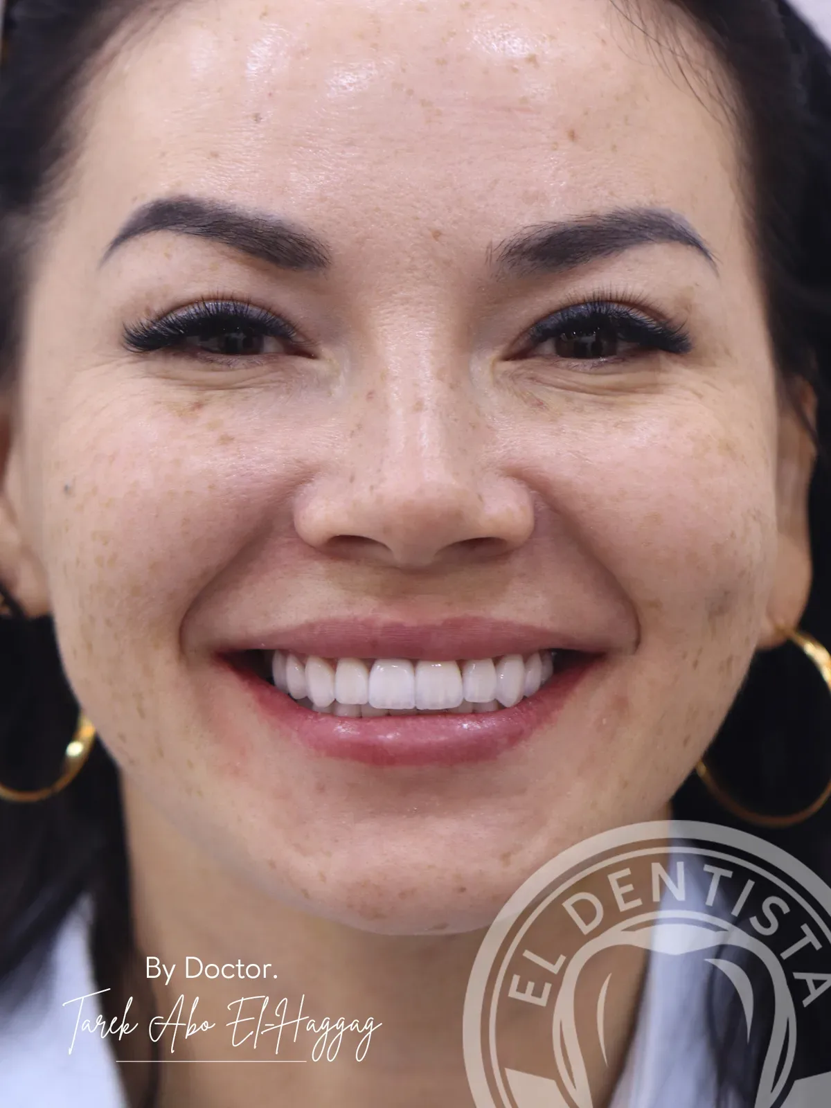 After: Smile