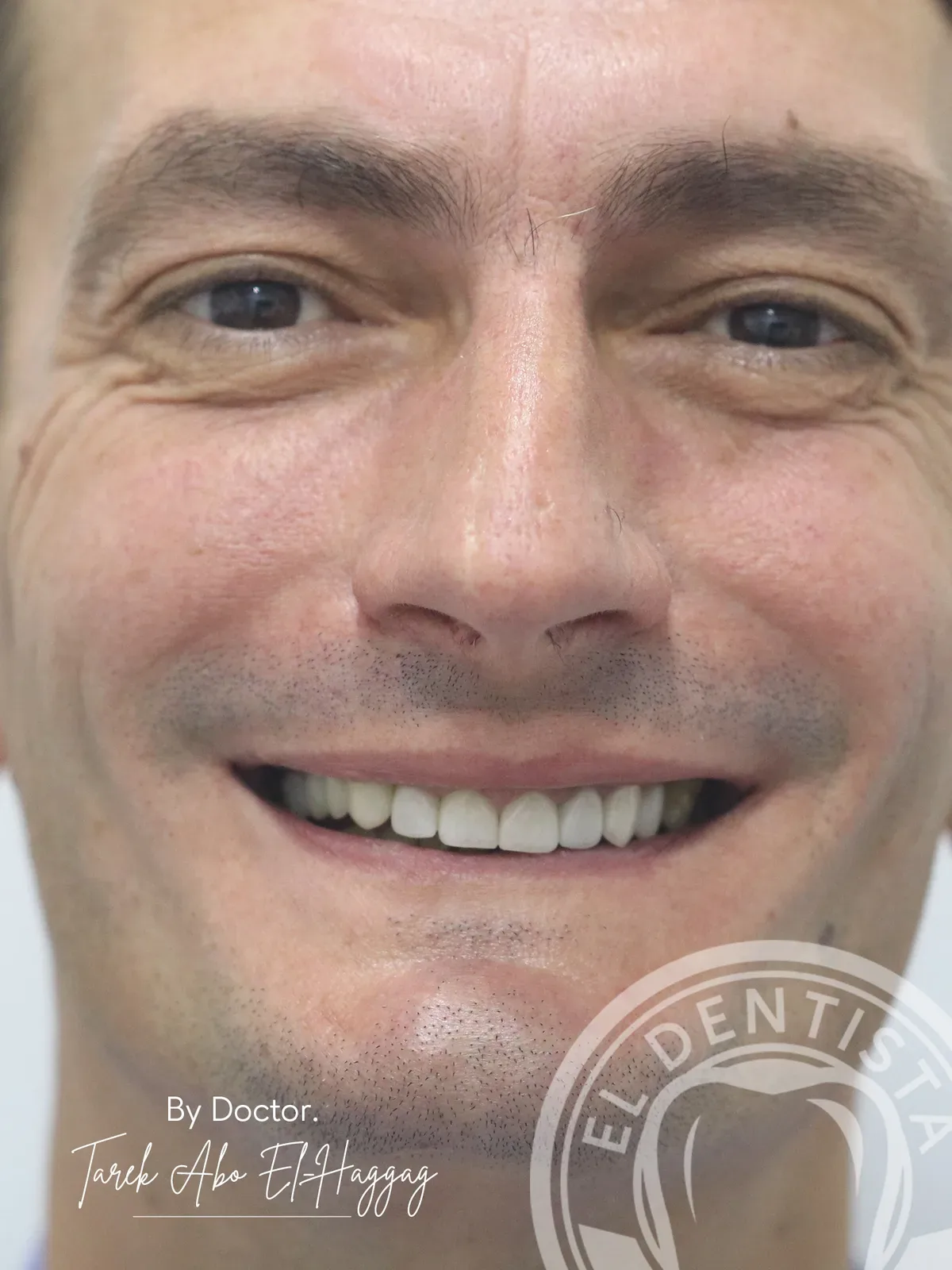 After: Smile