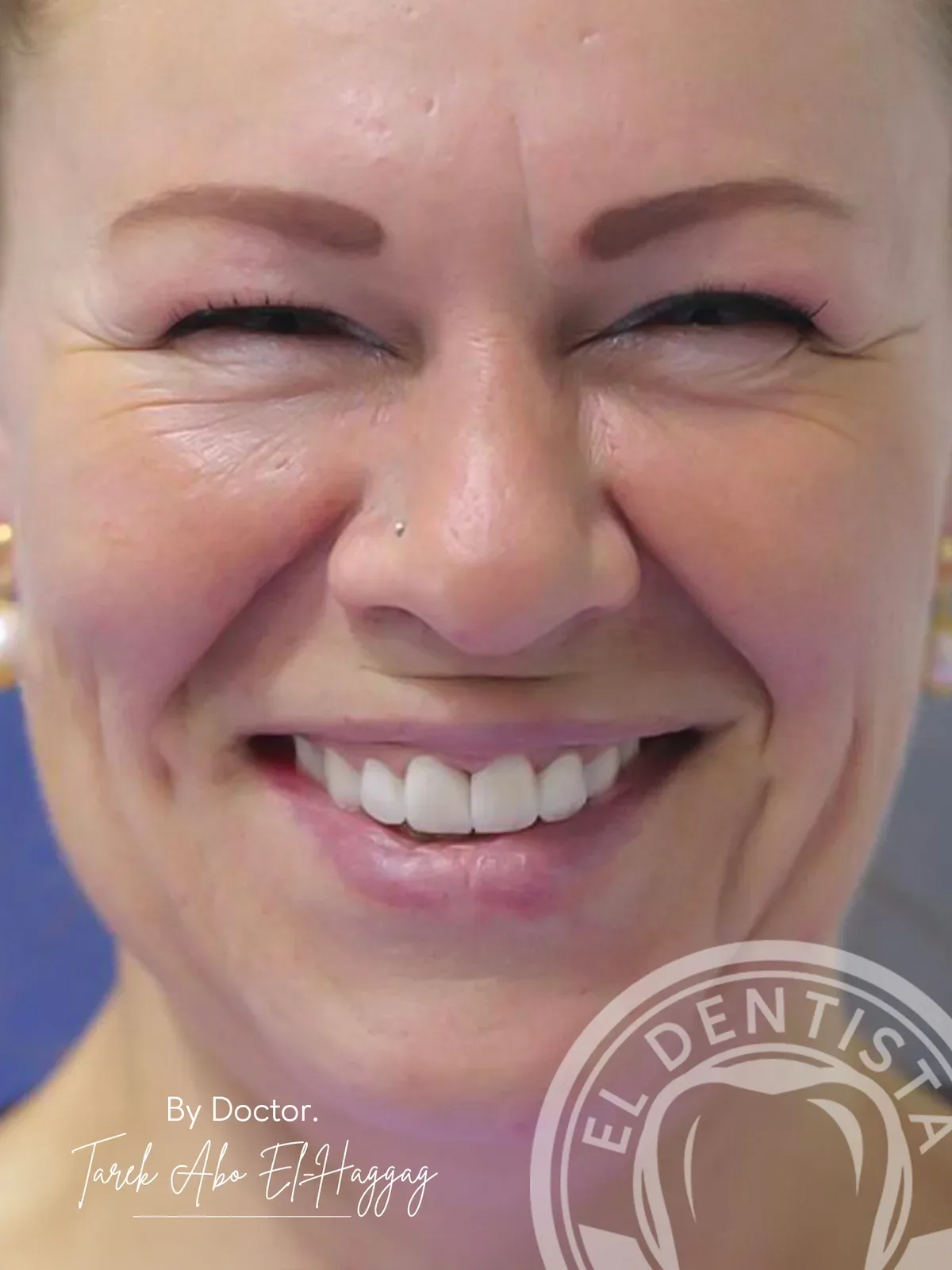 After: Smile