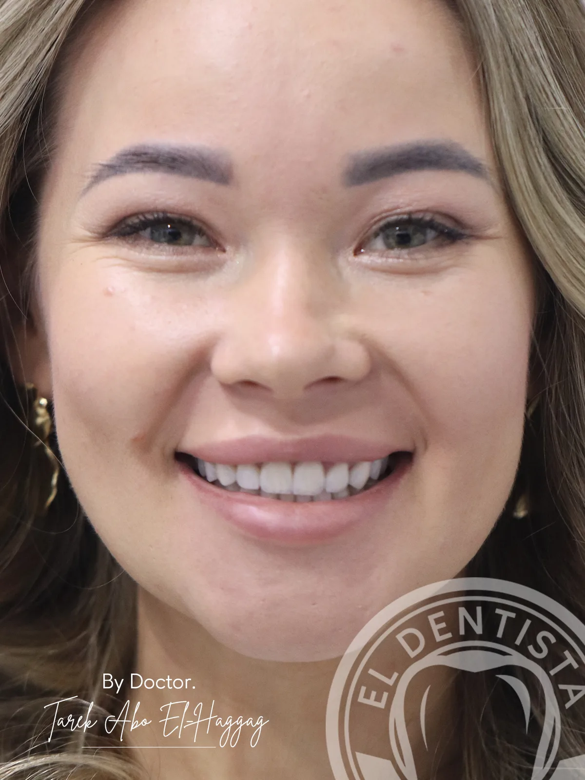 After: Feldspathic Veneers