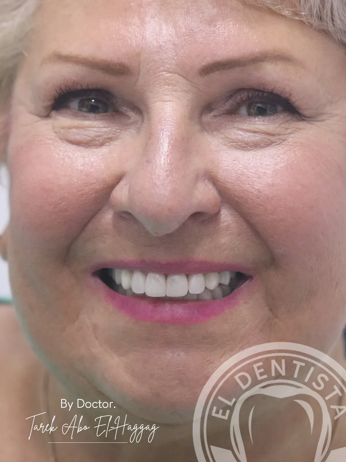After: Smile